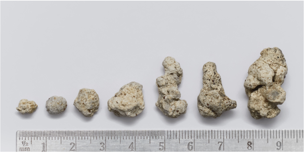 kidney stones