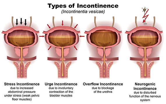 incontinence