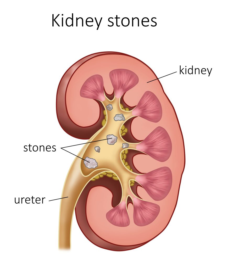 kidney stone