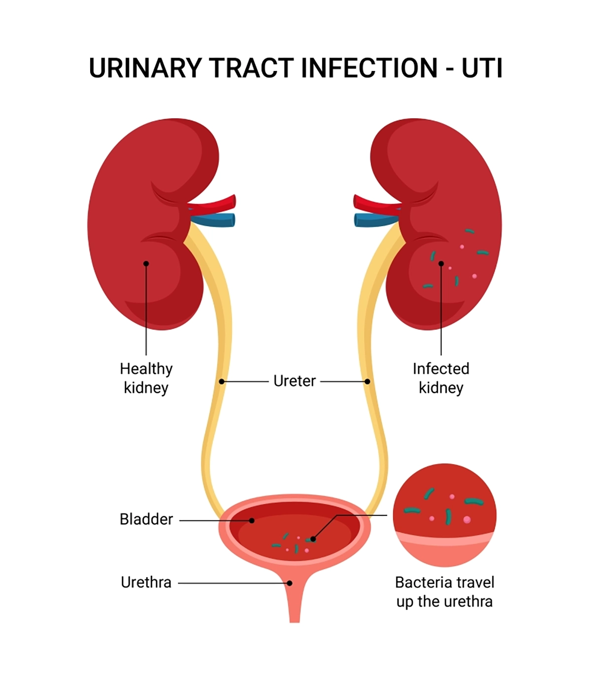 UTI