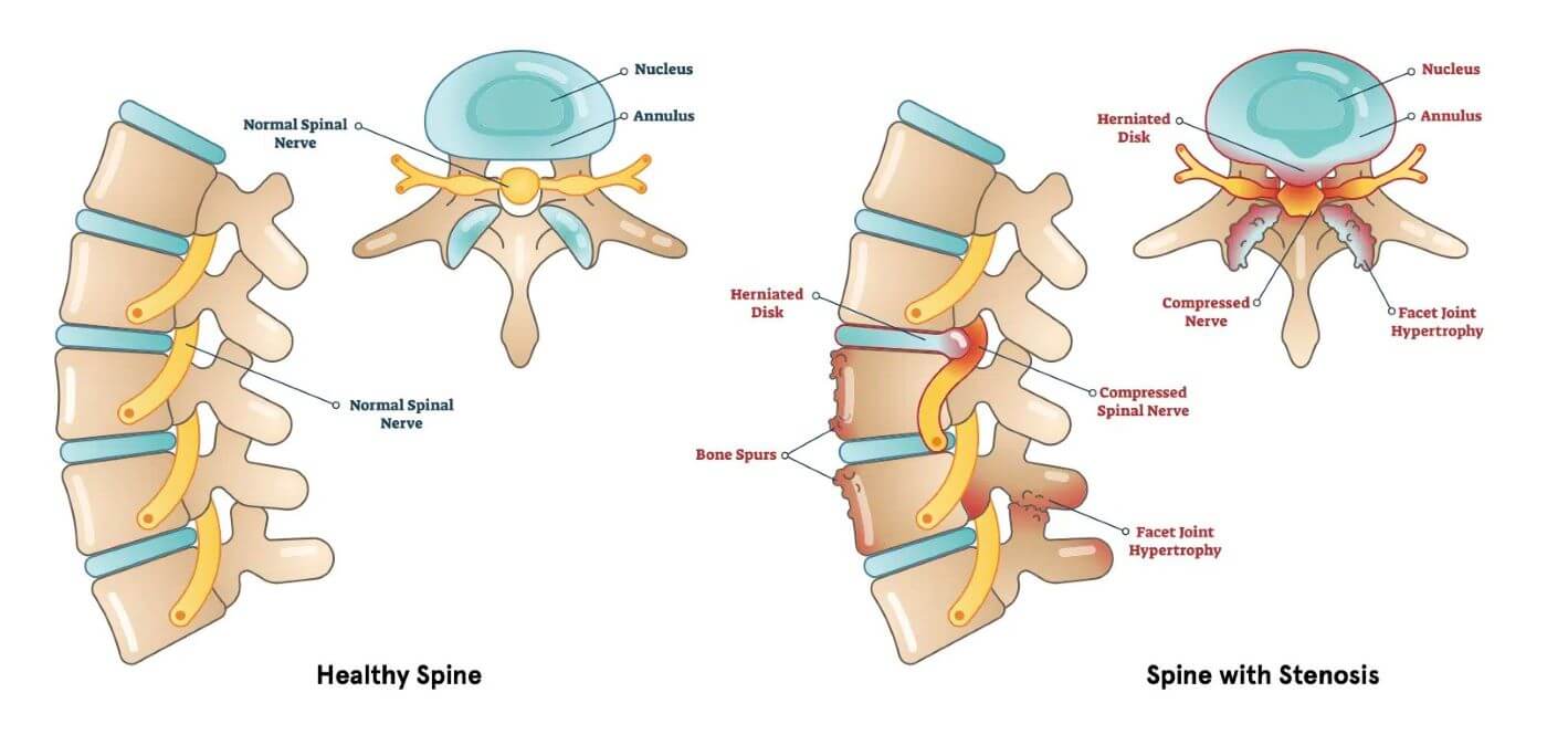 Spinal Stenosis image 4